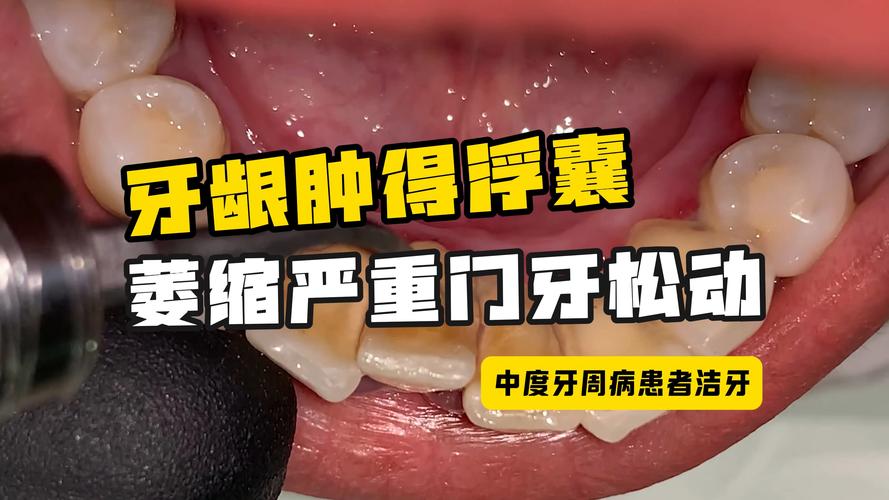 澳門城市大學(xué)研究生和牙周炎一次拔14顆牙與牙周炎一次拔14顆牙可以嗎