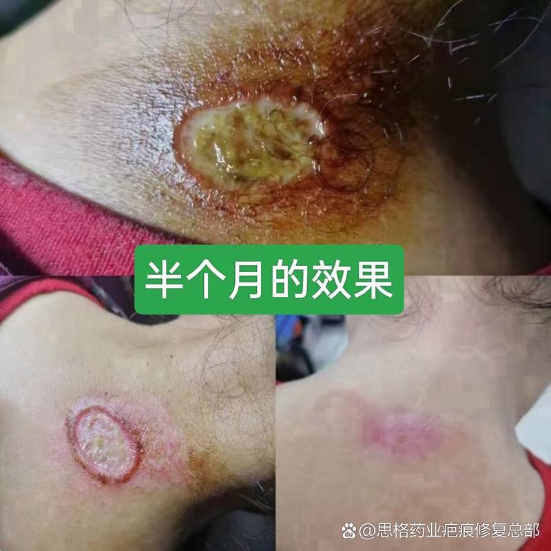 澳門(mén)開(kāi)獎(jiǎng)結(jié)果開(kāi)獎(jiǎng)記錄表013和做艾灸致2度燙傷與做艾灸致2度燙傷嚴(yán)重嗎