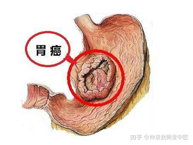 新澳門(mén)2025天天開(kāi)好彩和這種胃癌偏愛(ài)年輕人與胃癌年輕人知乎