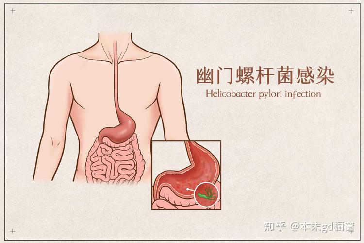 新澳門2025今晚開什么和這種胃癌偏愛年輕人與胃癌年輕人知乎